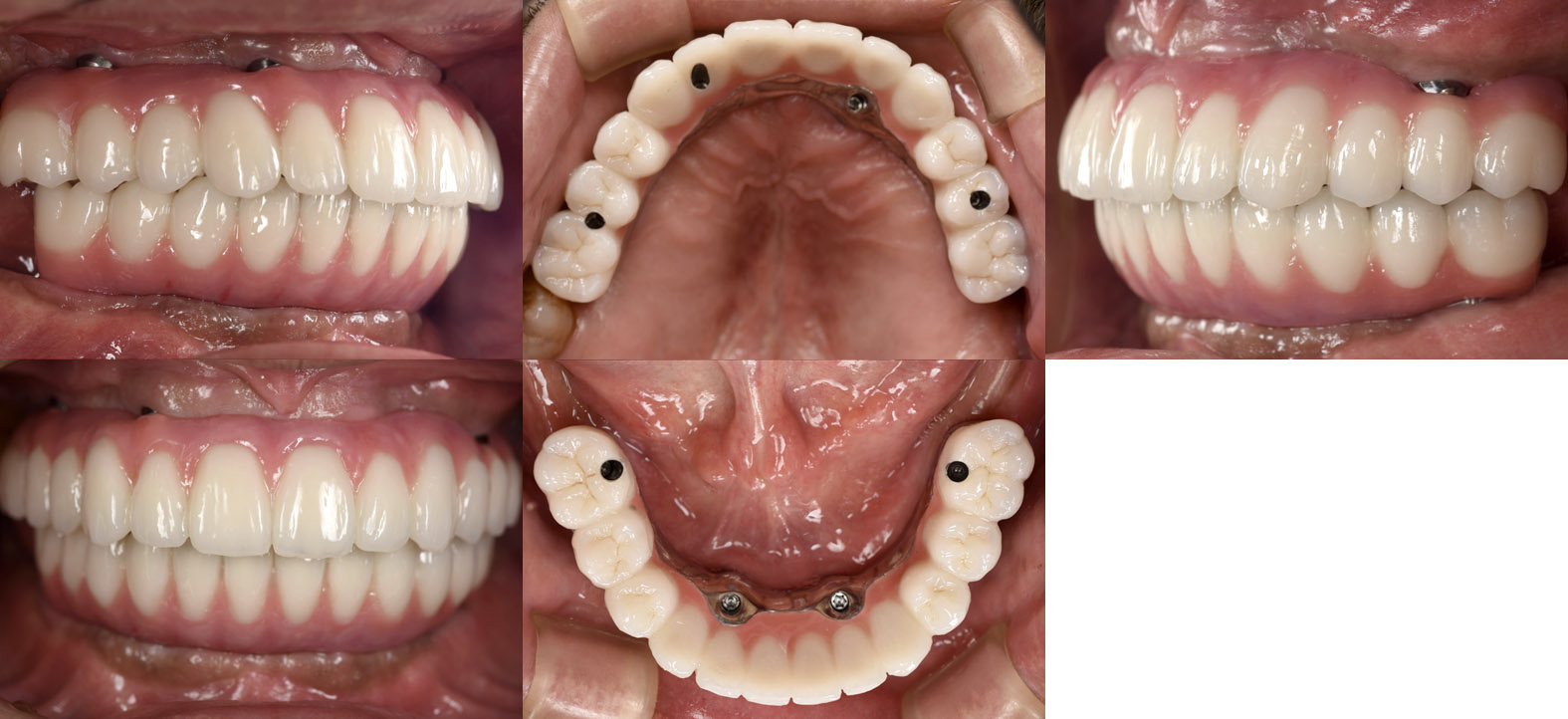 オールオンフォー 症例写真 口腔内写真（治療前）
