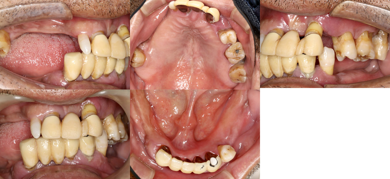 オールオンフォー 症例写真 口腔内写真（治療前）