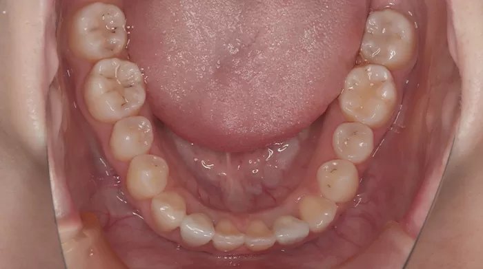 ガミースマイルを矯正治療で改善した症例