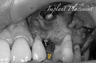 Implant Placement