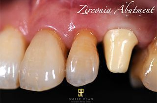 Zirconia Alatment