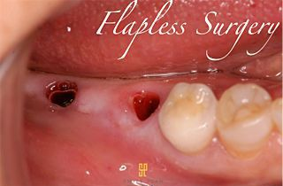 Flapless Surgery