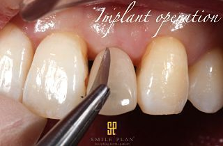 Implant operation