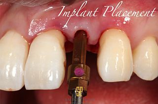 Implant Placement