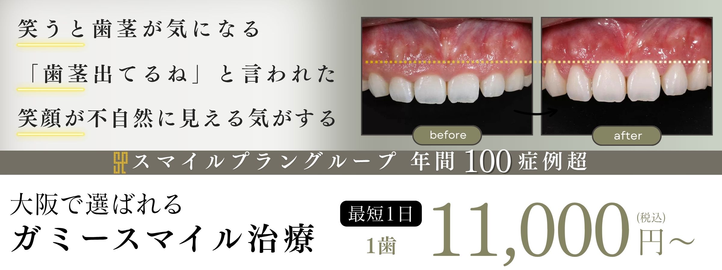 JR茨木駅のガミースマイル名医・最短1日1万円